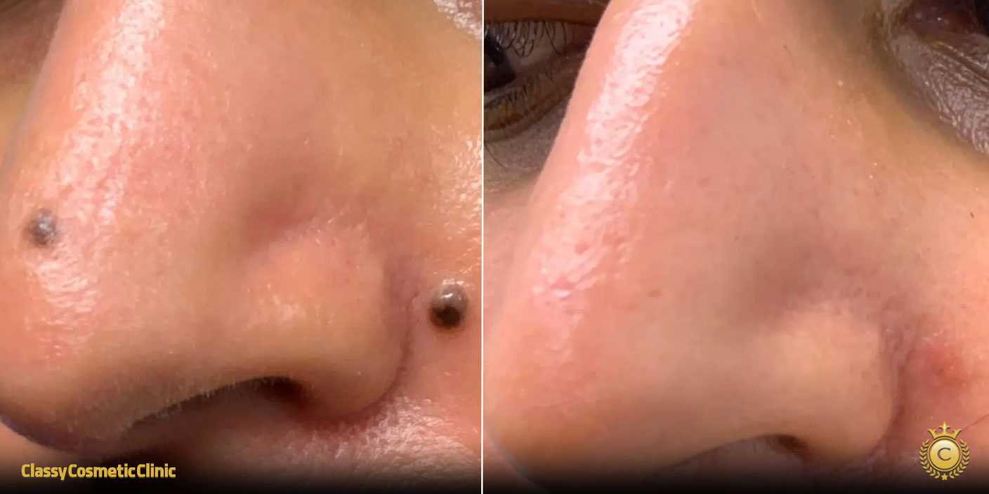 How to Get Rid of Moles on Nose before and after