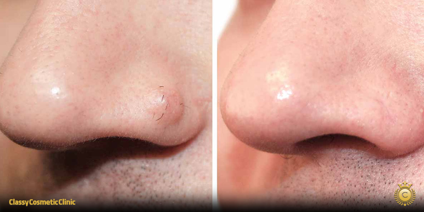 How to Get Rid of Moles on Nose before and after