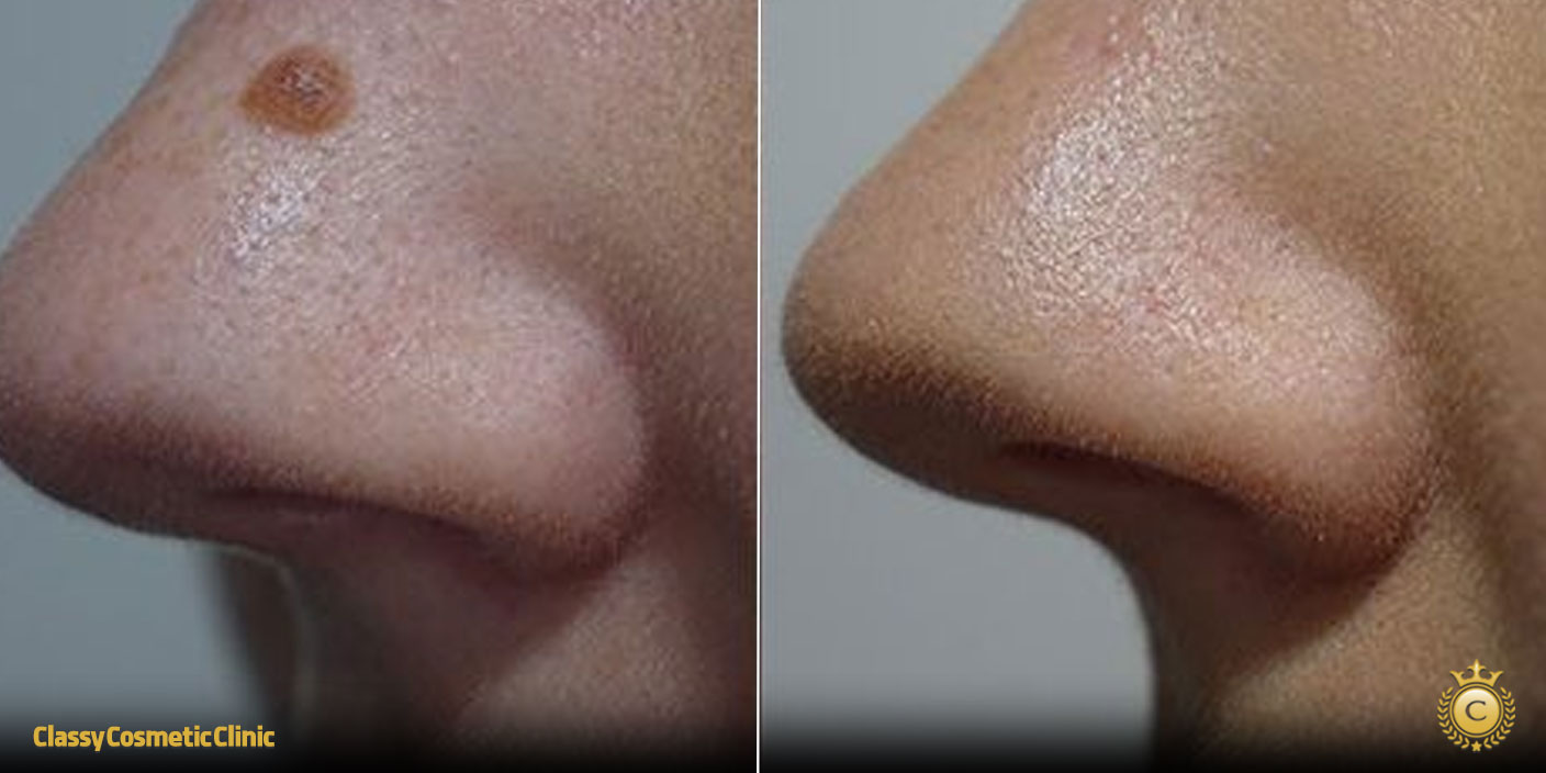 How to Get Rid of Moles on Nose before and after