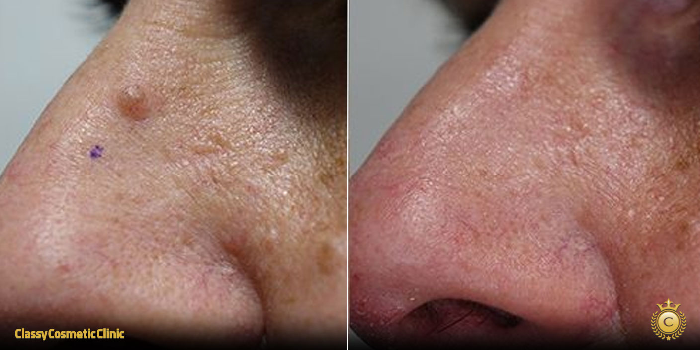 How to Get Rid of Moles on Nose before and after