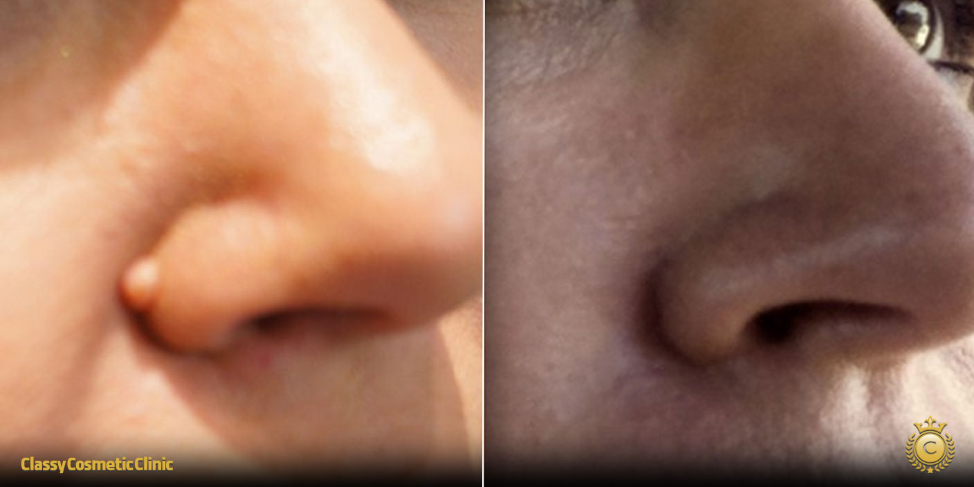 How to Get Rid of Moles on Nose before and after