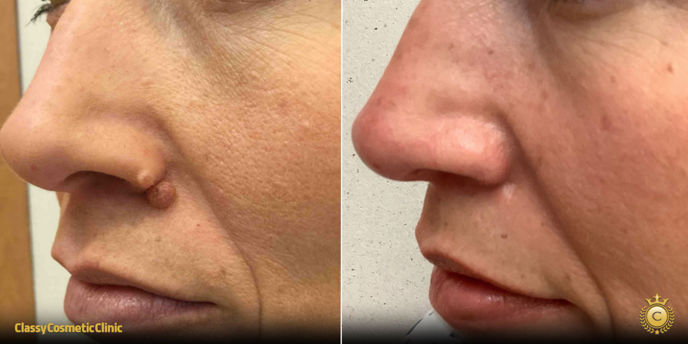 How to Get Rid of Moles on Nose before and after