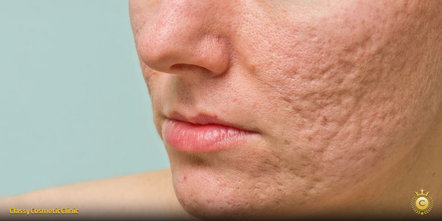 Top 3 Acne Scar Treatments in Markham: PRP Facials, Microneedling & Chemical Peels