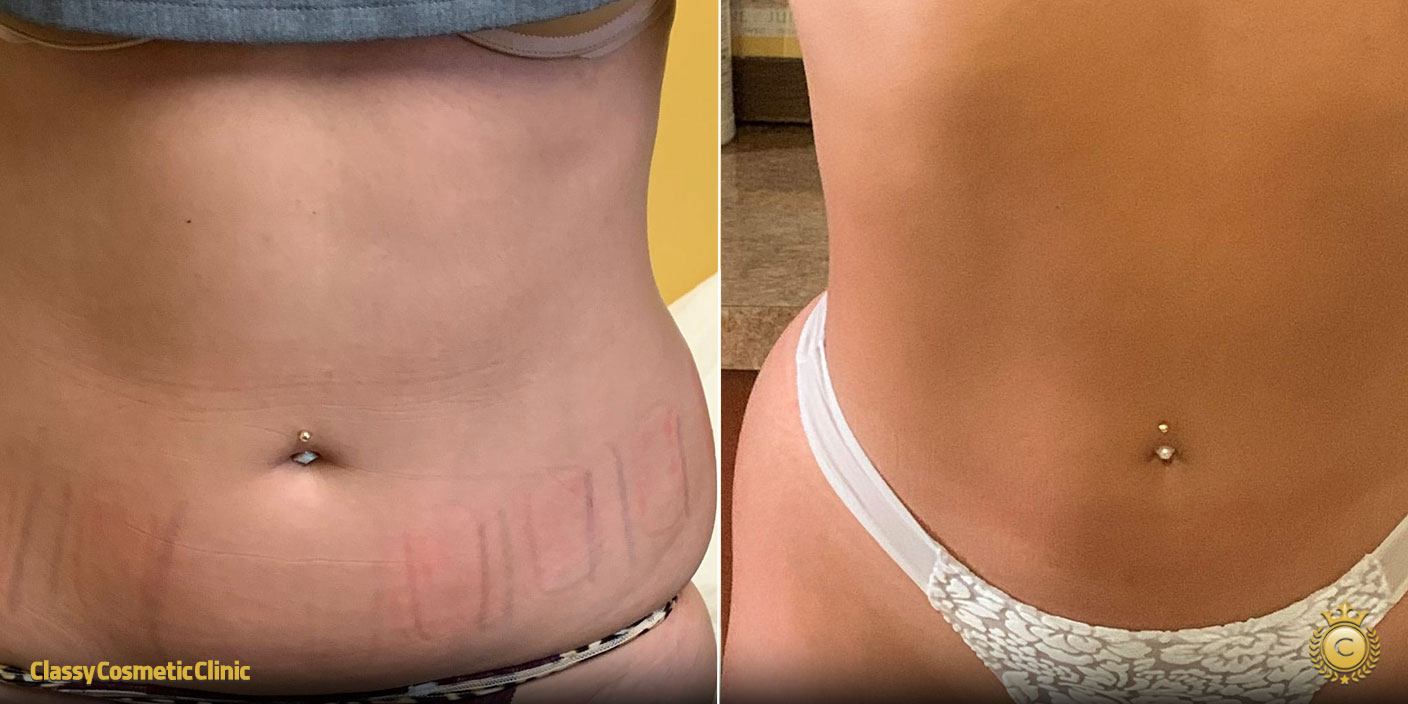 Risks & Benefits of Body Contouring: before and after