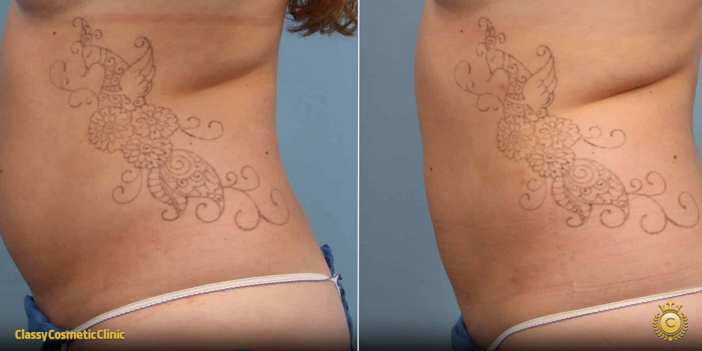 Body Contouring: before and after