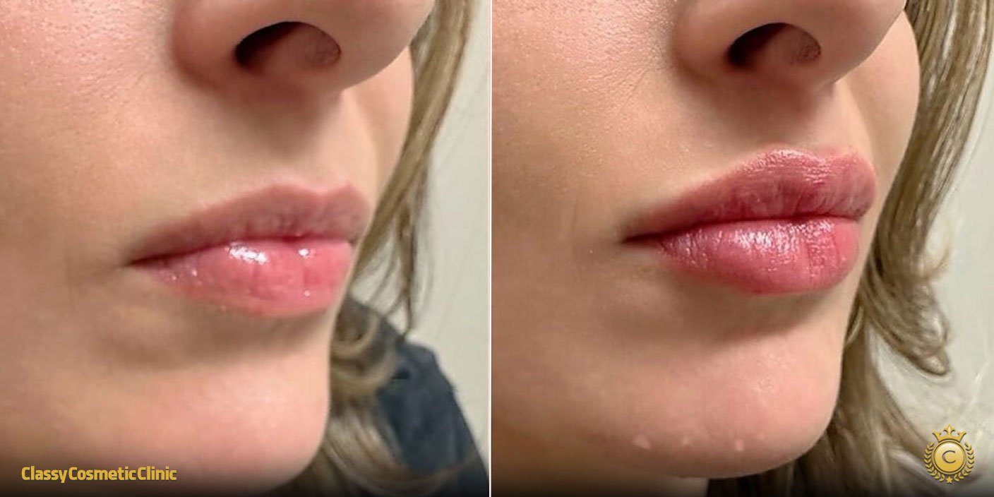 filler migration before and after
