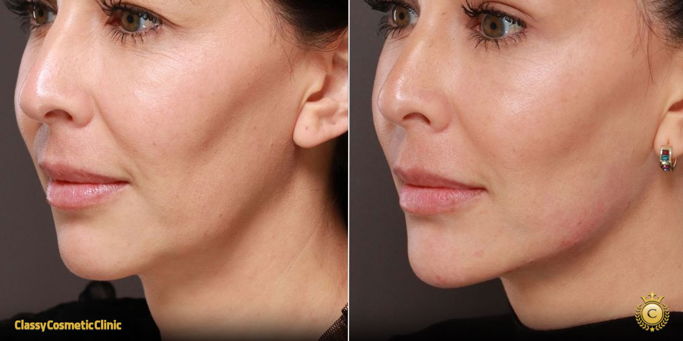 best jawline filler before abd after