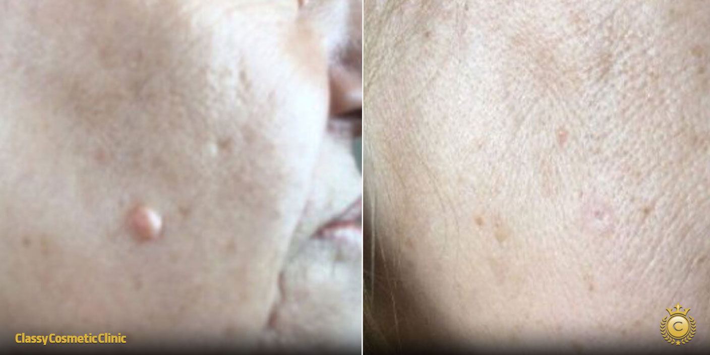 Can You Remove Moles Naturally? Myths vs. Facts